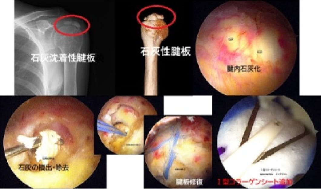石灰沈着性腱板炎