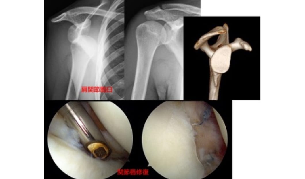 反復性肩関節脱臼