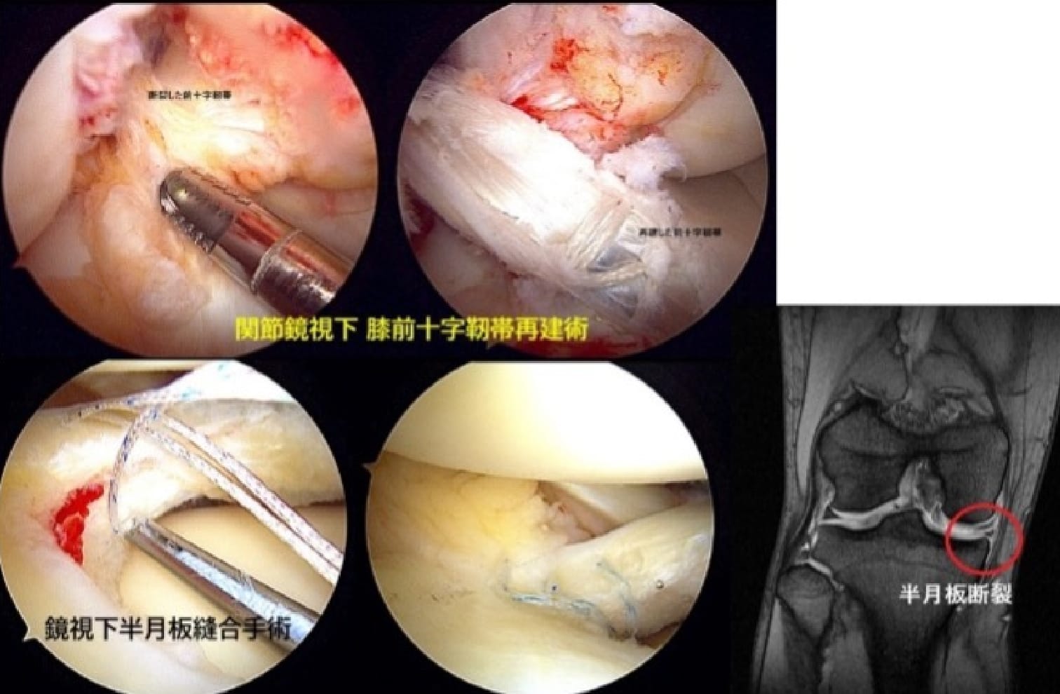 関節鏡視下手術2