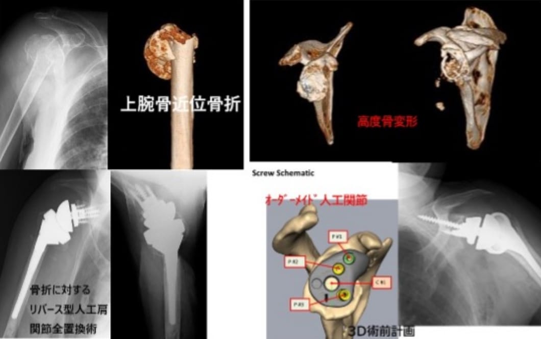 患者さんの骨の形に合わせるオーダーメイド・リバース型人工肩関節